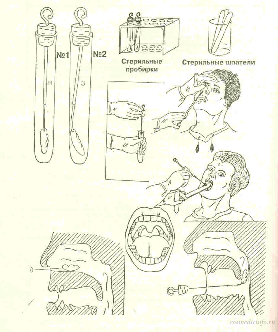 Забор мазка из зева для бактериологического исследования