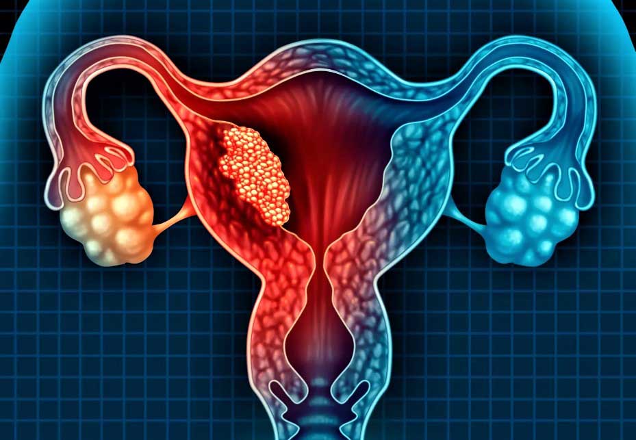 Ответы к тестам НМО: "Лекарственная терапия рака тела матки, саркомы матки"
