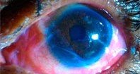 Повязки из плаценты могут избавить от операций на глазах