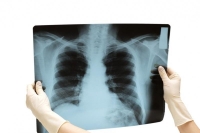 Подготовка пациента к рентгену при заболеваниях и повреждениях грудной клетки