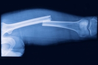 Диагностирование перелома костей таза,  позвоночника и трубчатых костей