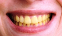 О чем говорит желтый цвет зубов?