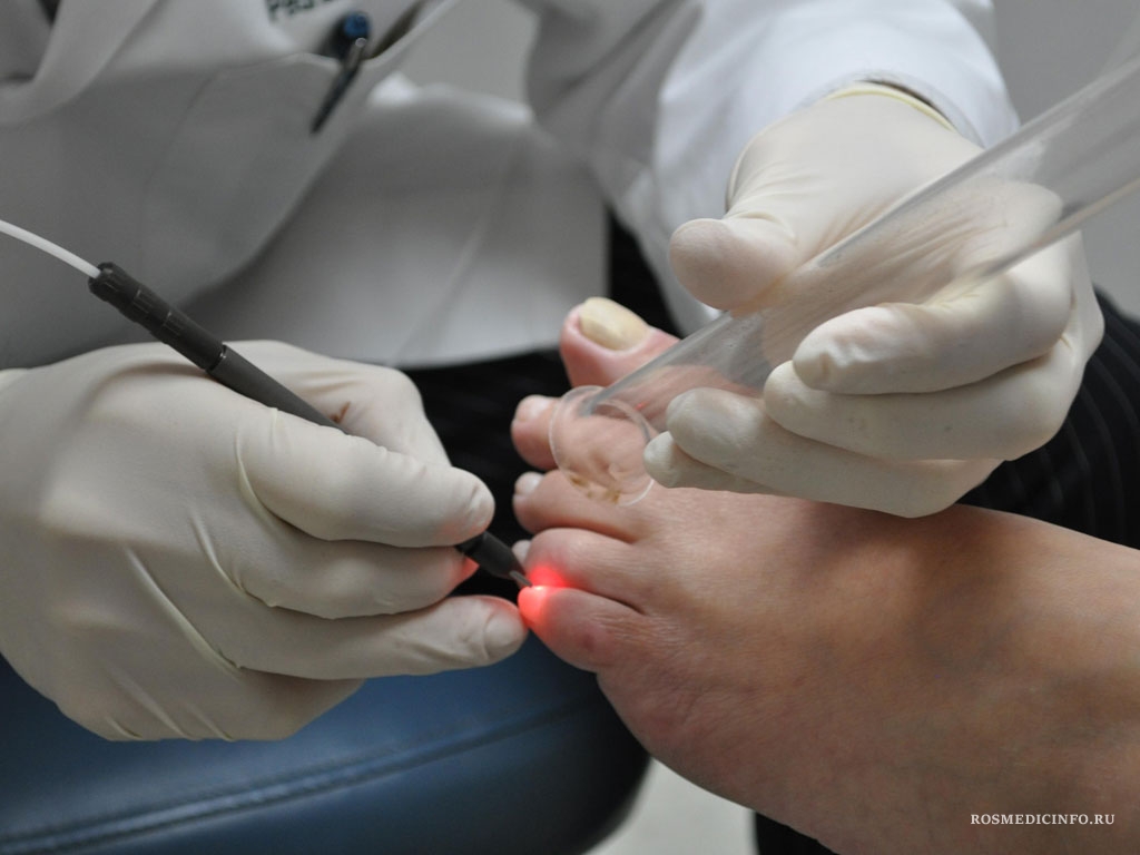 Удаление вросшего ногтя лазером: все преимущества метода лечения
