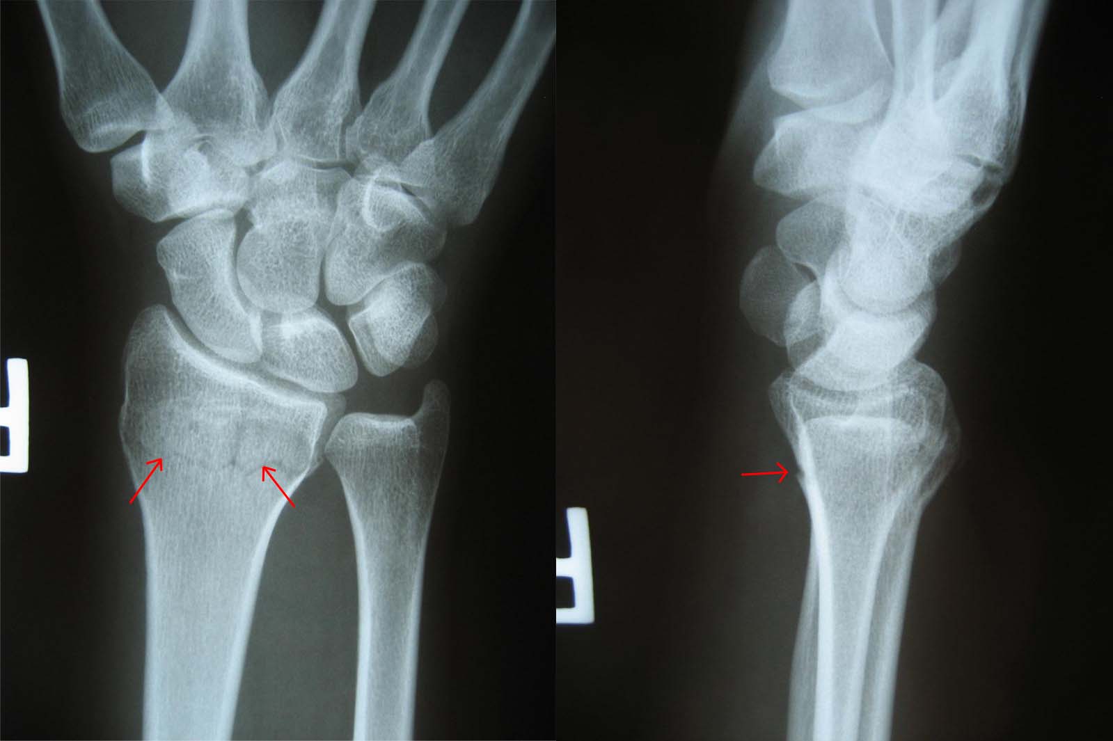 Консолидирующийся перелом левой лучевой кости в типичном месте