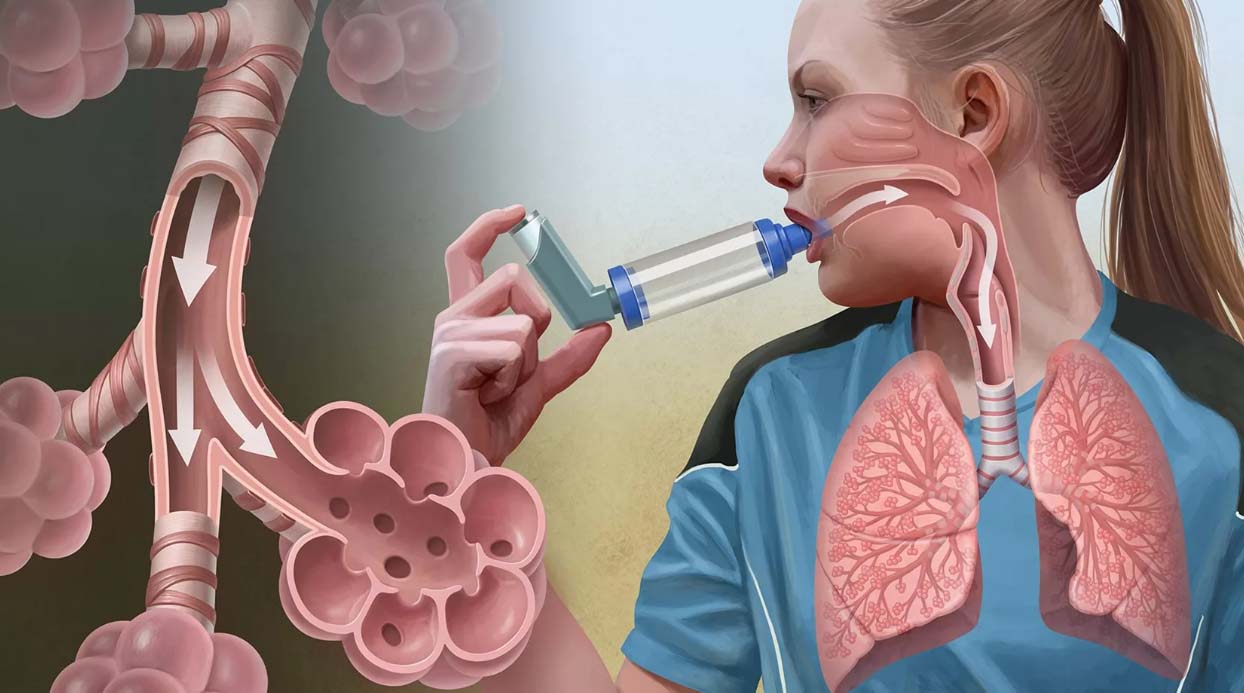 Ответы к ситуационной задаче: "Бронхиальная астма, среднетяжелое течение"