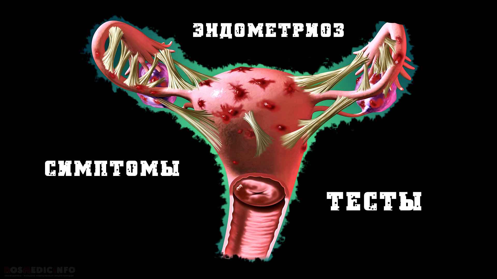 Эндометриоз. Симптомы и тесты