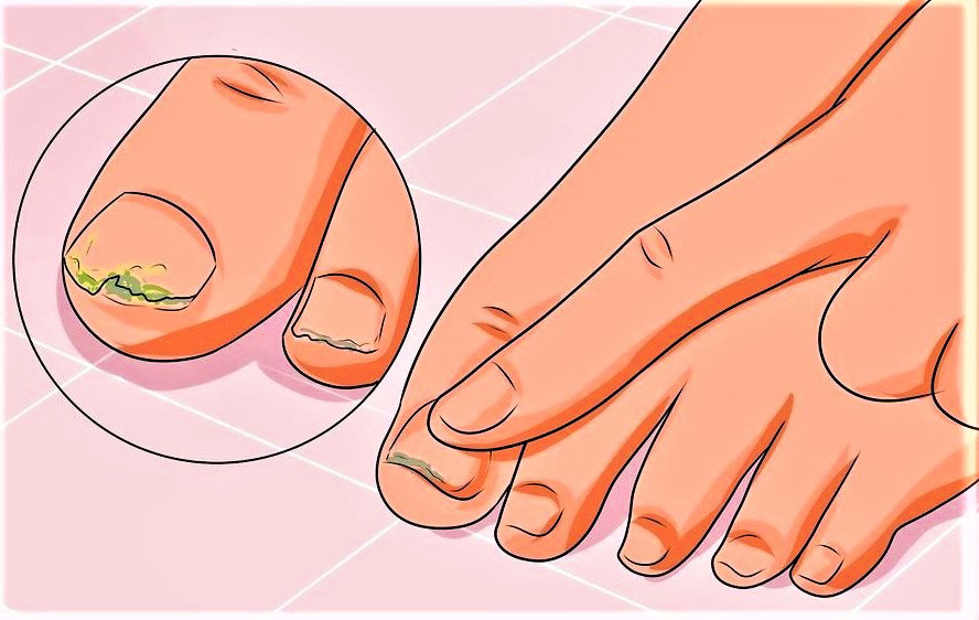 Ответы к тестам НМО: "Грибок ногтей"