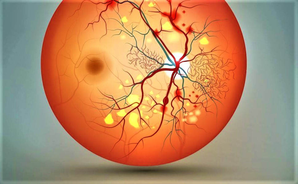 Ответы к тестам НМО: «Современные подходы к лечению посттромботической ретинопатии»