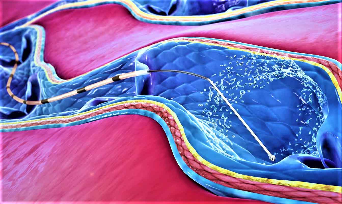 Ответы к тестам НМО: "Эндовенозная лазерная облитерация как метод лечения варикозной болезни"