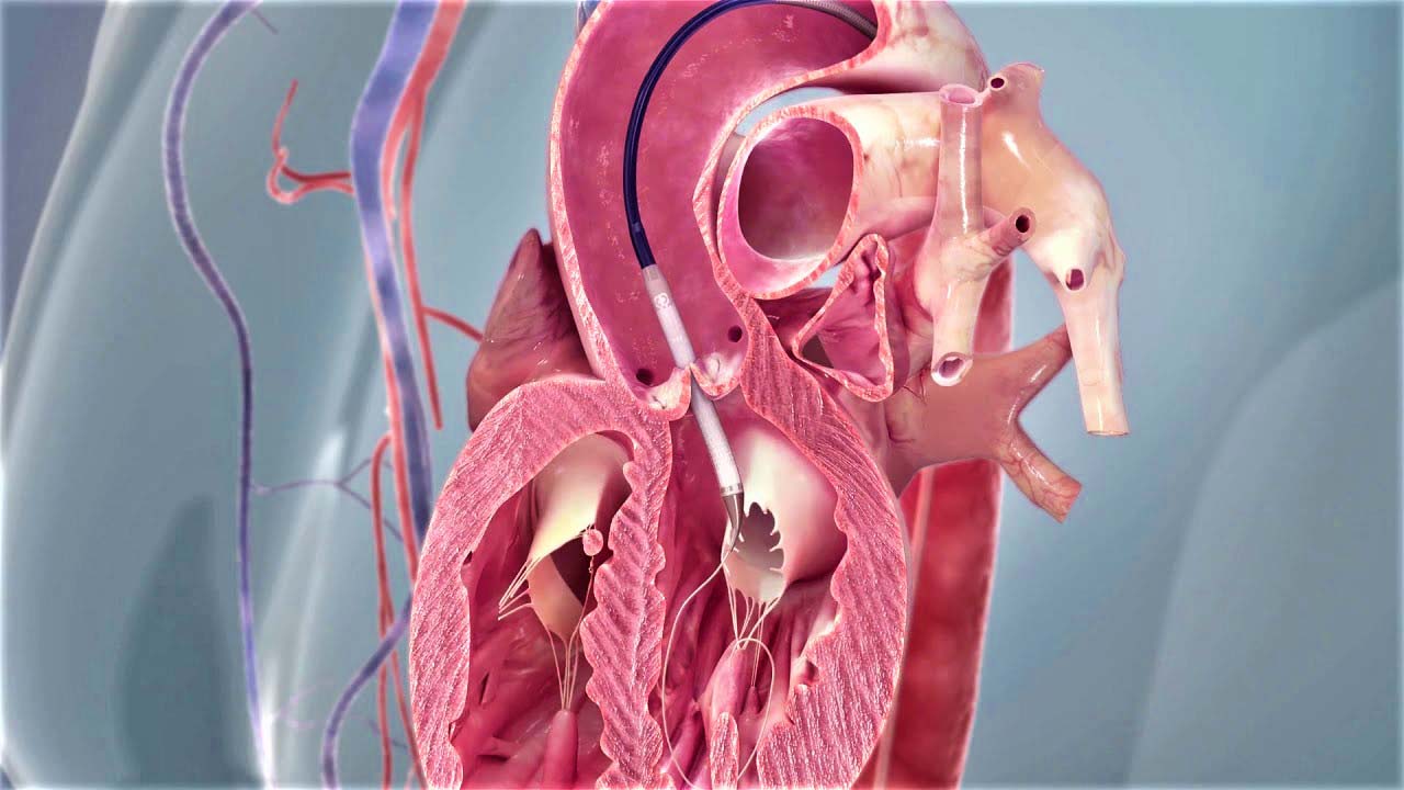 Ответы к тестам НМО: "Рентгенэндоваскулярные вмешательства у пациентов с патологией аортального клапана"