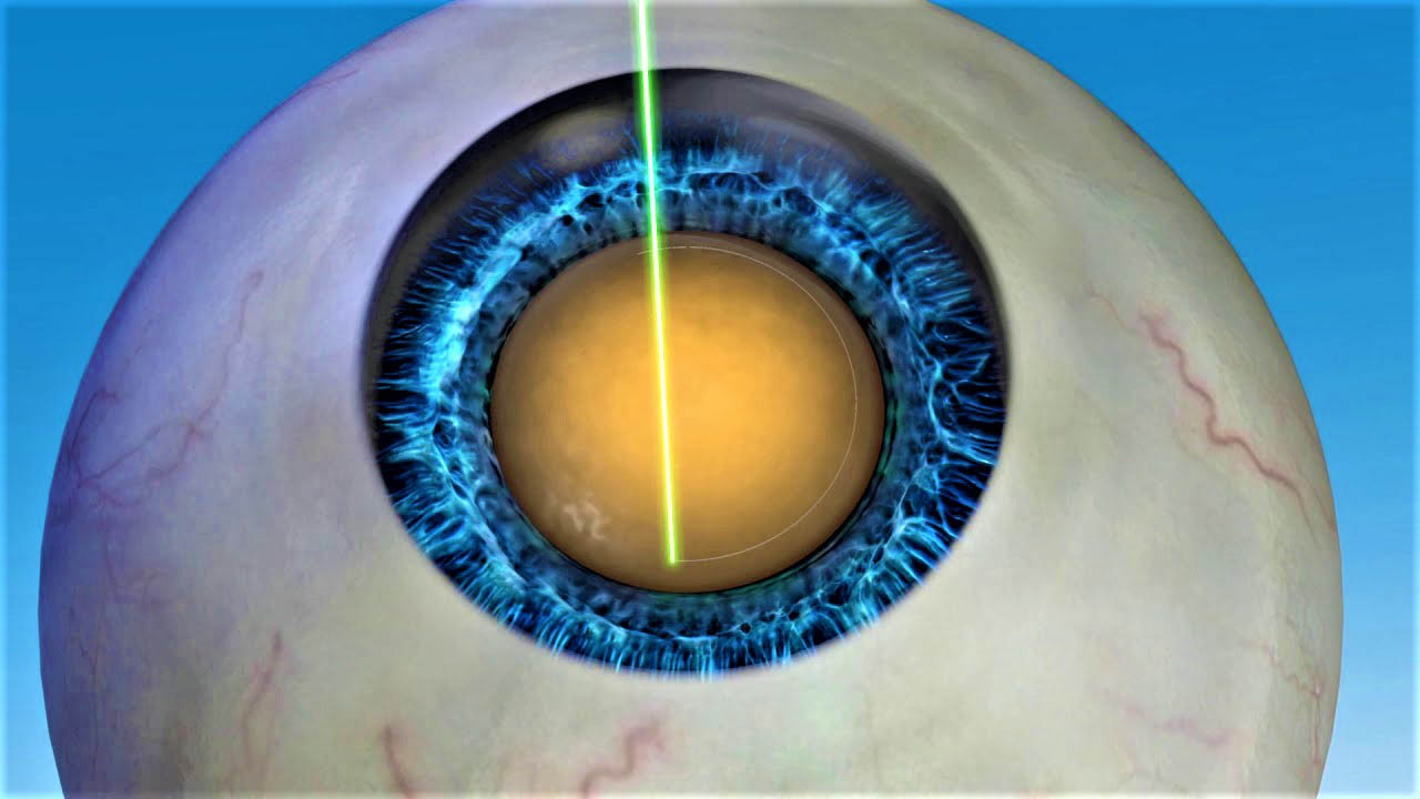 Ответы к тестам НМО: "Факоэмульсификация катаракты при узком зрачке"