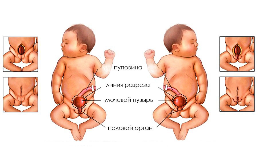 Ответы к тестам НМО: "Экстрофия мочевого пузыря у детей (по утвержденным клиническим рекомендациям)"