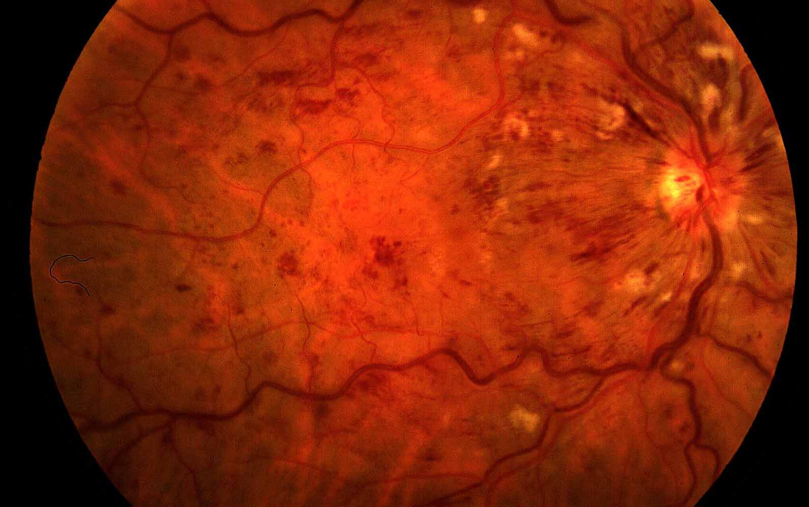 Ответы к тестам НМО: "Глазное дно при гипертонической болезни"
