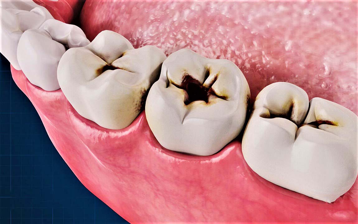 Ответы к тестам НМО: "Кариес зубов. Определение кариеса зубов. Распространенность и интенсивность кариеса"