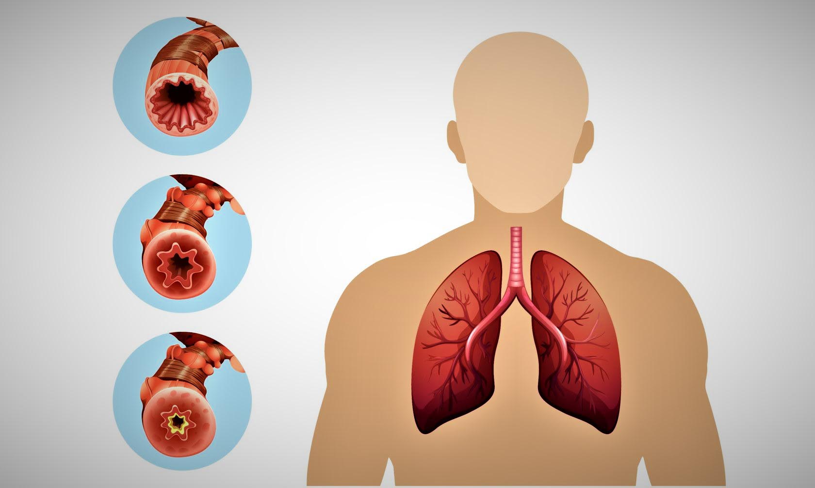 Ответы к тестам НМО: "Сестринский процесс при бронхообструктивных заболеваниях: хроническая обструктивная болезнь легких (ХОБЛ) и бронхиальная астма (БА)"