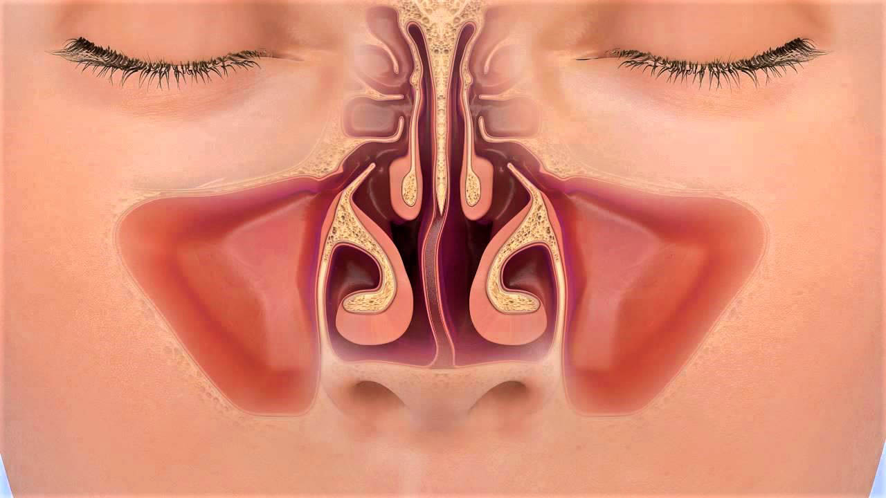 Искривление носовой перегородки: симптомы и причины искривления, лечение.