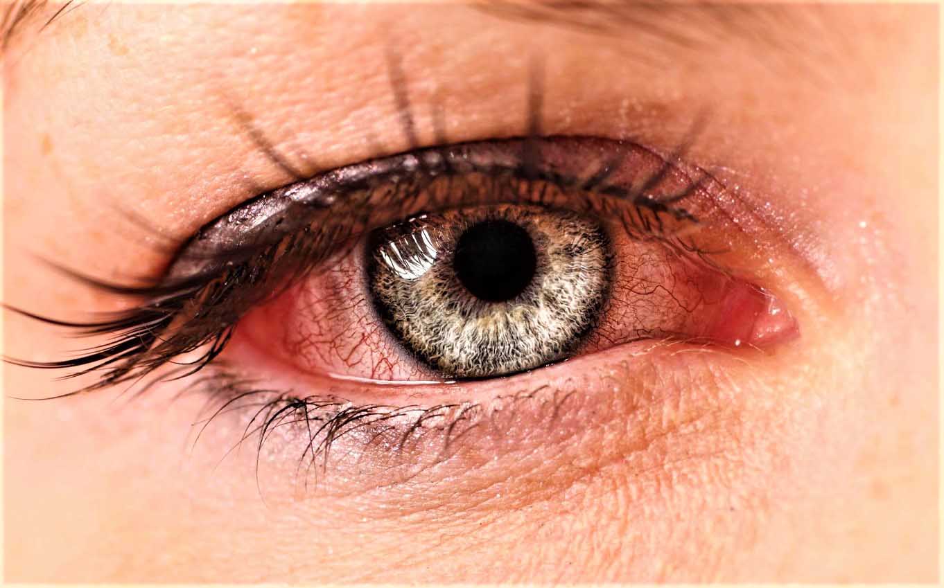 Герпетические заболевания глаз