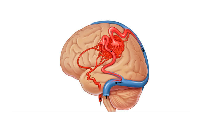 Ответы к тестам НМО: "Артериовенозные мальформации головного мозга: выбор тактики лечения и принципы микрохирургического лечения"