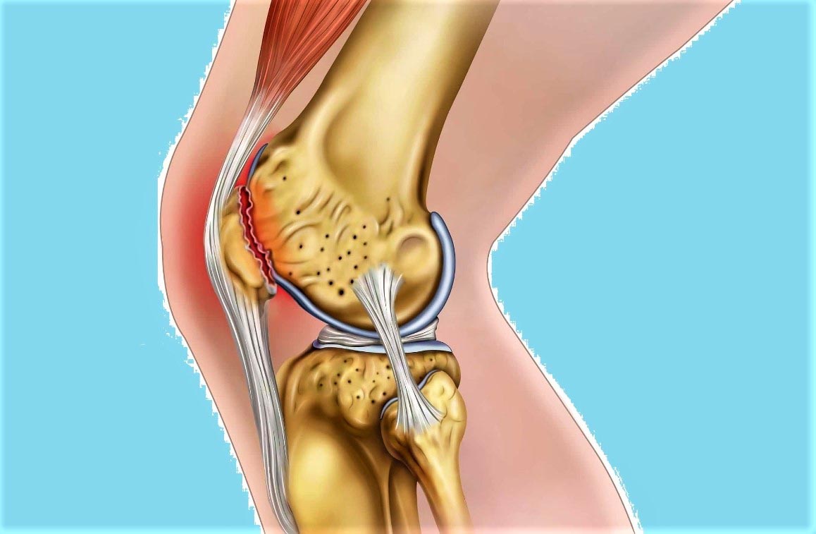 Ответы к тестам НМО: "Хондромаляция и другие повреждения хряща коленного сустава (по утвержденным клиническим рекомендациям)"