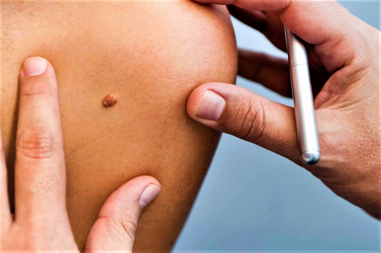 Ответы к тестам НМО: "Современное лекарственное лечение меланомы кожи"