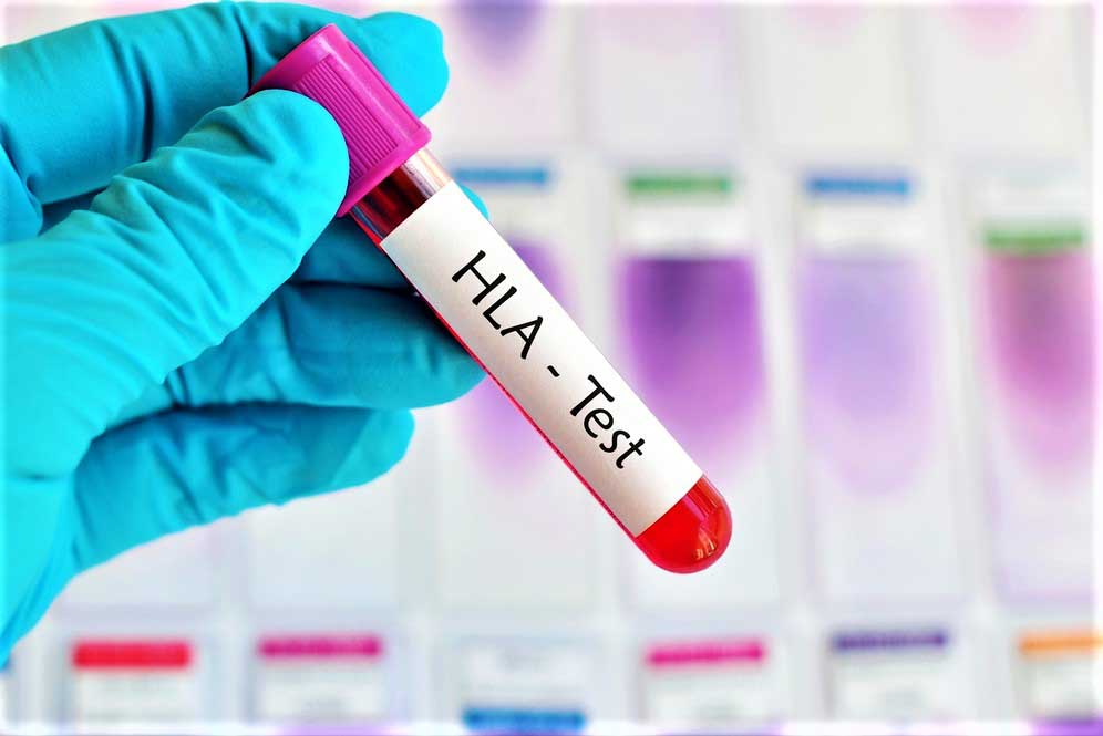 Ответы к тестам НМО: "Связь HLA с болезнями. HLA-типирование"