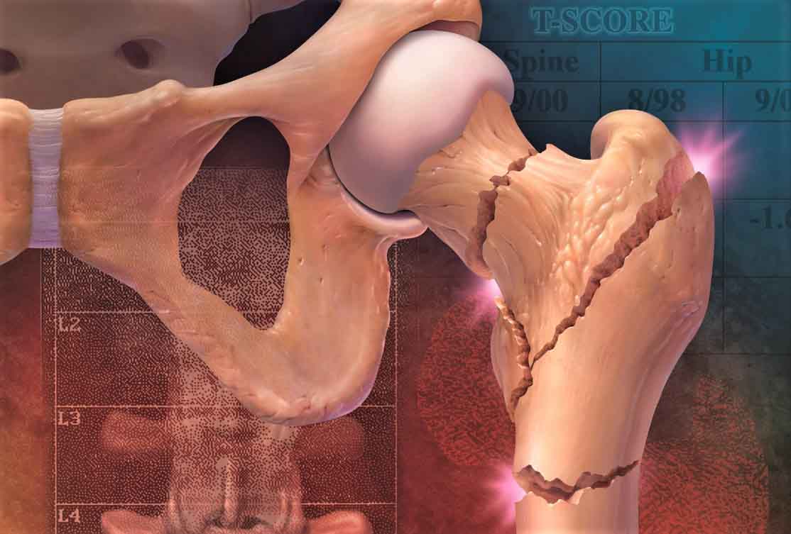 Ответы к тестам НМО: "Переломы проксимального отдела бедренной кости (по утвержденным клиническим рекомендациям)"