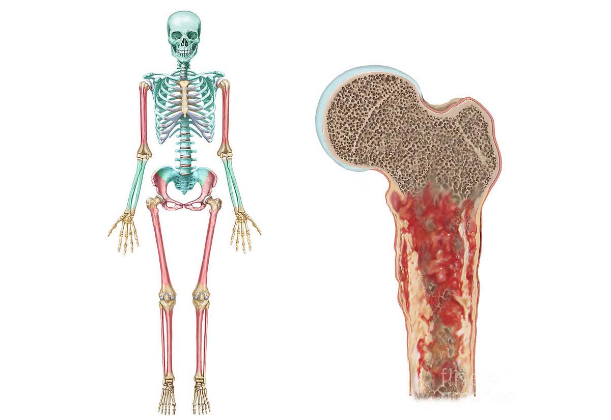 Ответы к тестам НМО: "Лечение сарком костей"