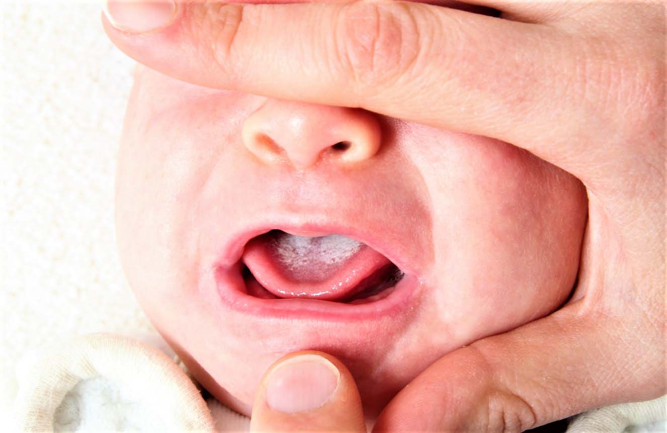 Ответы к тестам НМО: "Особенности диагностики и лечения инвазивного кандидоза у новорожденных"