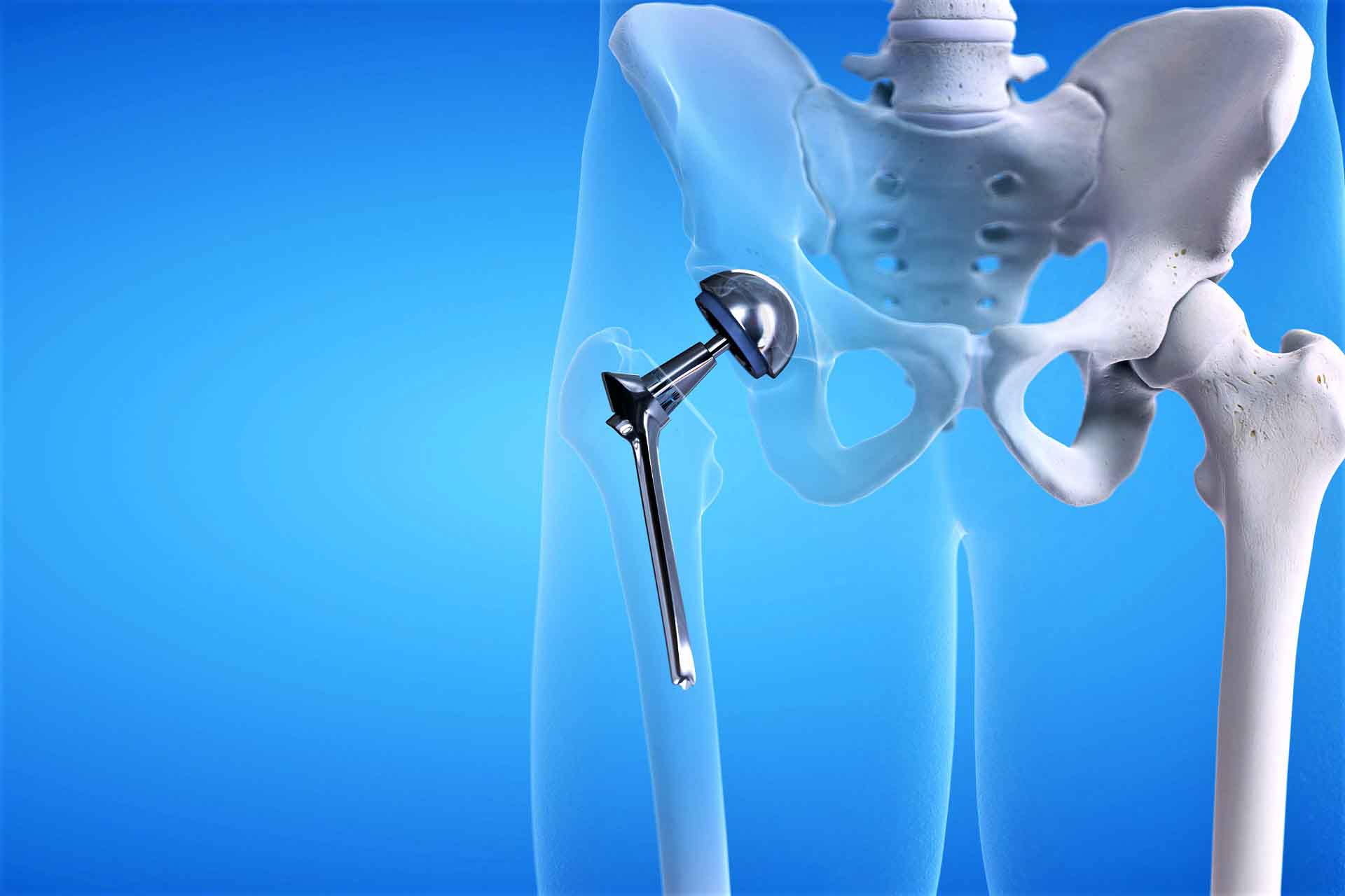Ответы к тестам НМО: "Осложнения, связанные с внутренними ортопедическими протезными устройствами имплантатами и трансплантатами тазобедренного сустава (по утвержденным клиническим рекомендациям)"