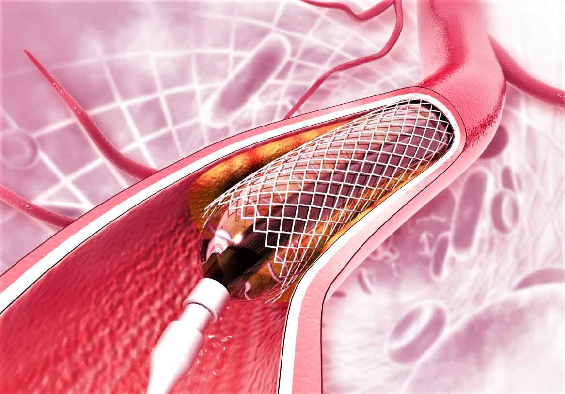 Ответы к тестам НМО: "Амбулаторное ведение больных ишемической болезнью сердца после чрескожного коронарного вмешательства: стентирования коронарных артерий"