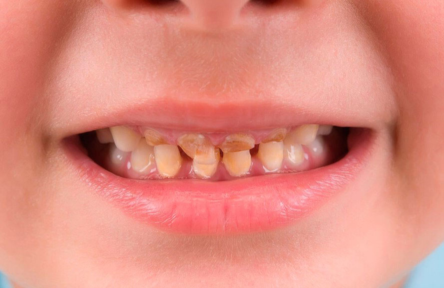 Ответы к тестам НМО: "Некариозные поражения твердых тканей зубов, развивающиеся до и после прорезывания зубов"