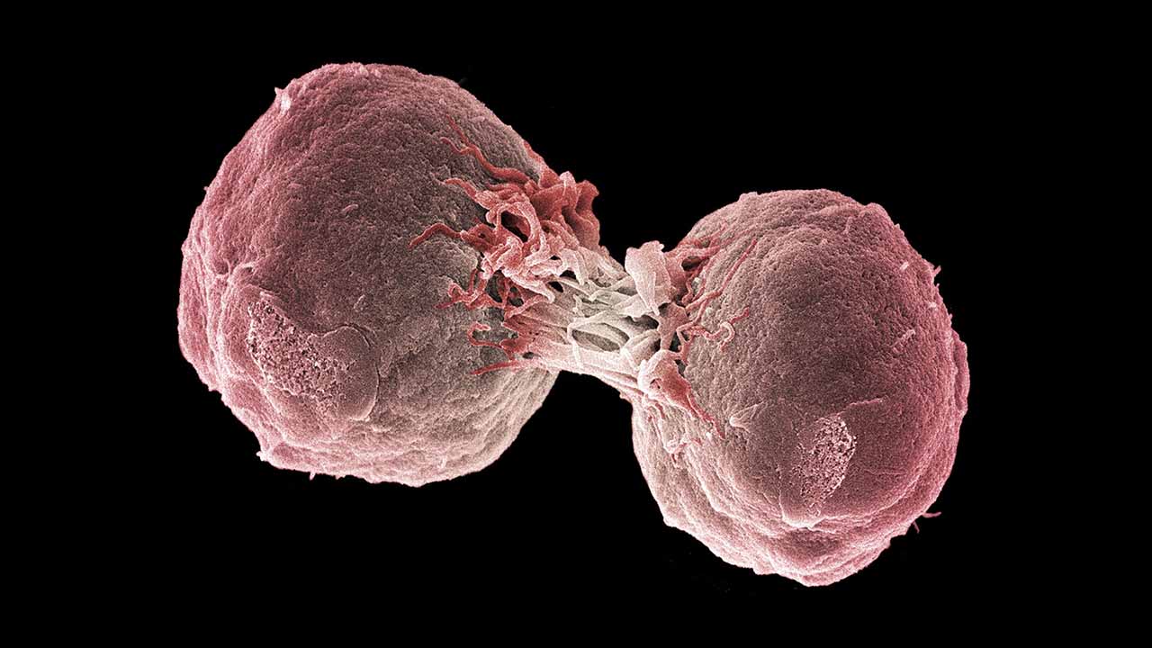 Ответы к тестам НМО: "Лимфома из клеток маргинальной зоны у взрослых (по утвержденным клиническим рекомендациям)"