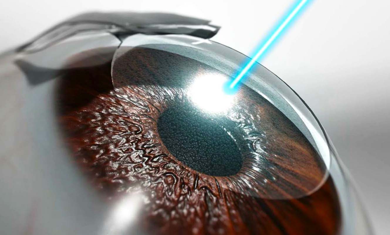 Ответы к тестам НМО: "Лазерные методы лечения глаукомы (офтальмология)"