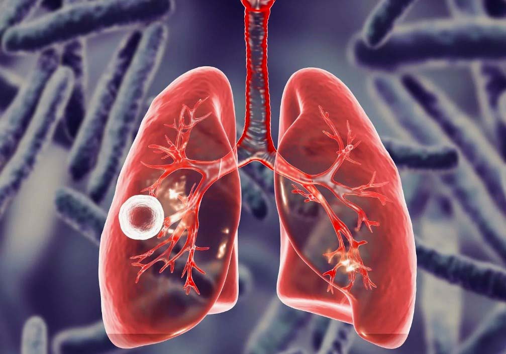 Туберкулёз: классификация, симптомы, диагностика, лечение, профилактика