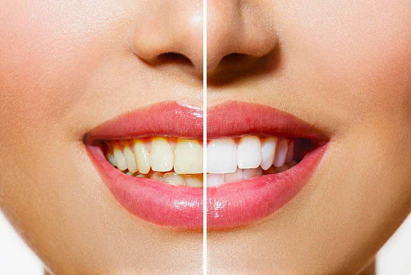 Как восстановить естественную белизну зубов