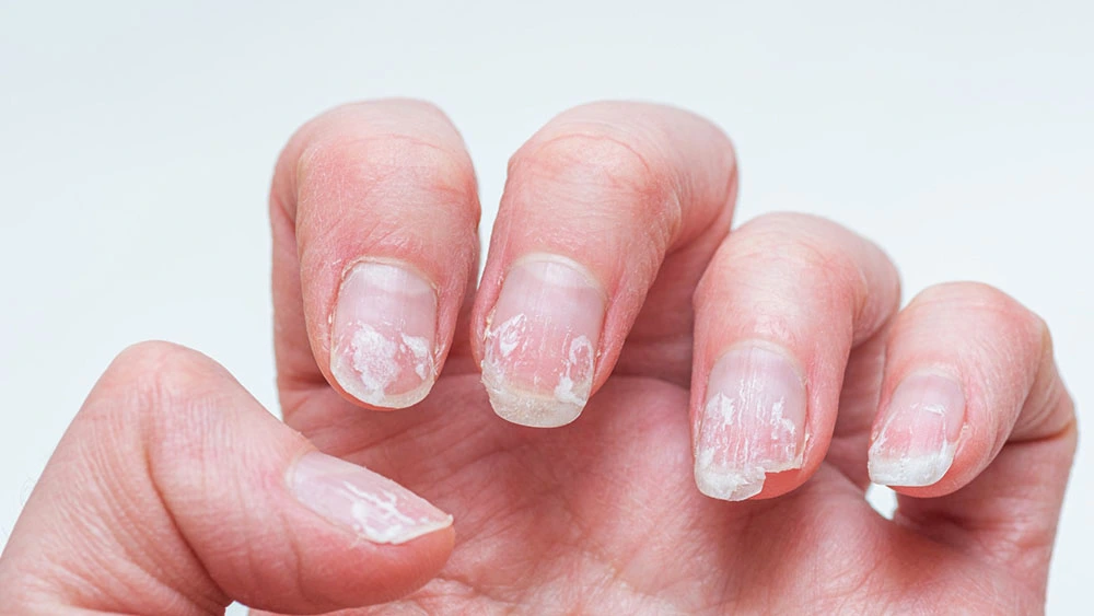Слоящиеся ногти: это симптом? Что делать?