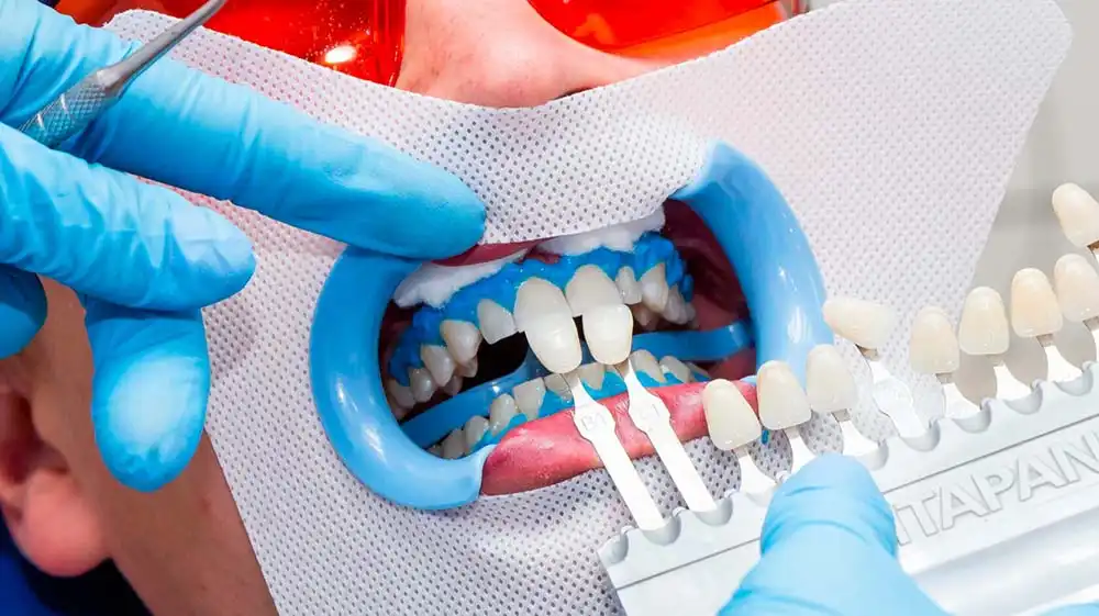 Проблемы повышенной чувствительности при отбеливании зубов