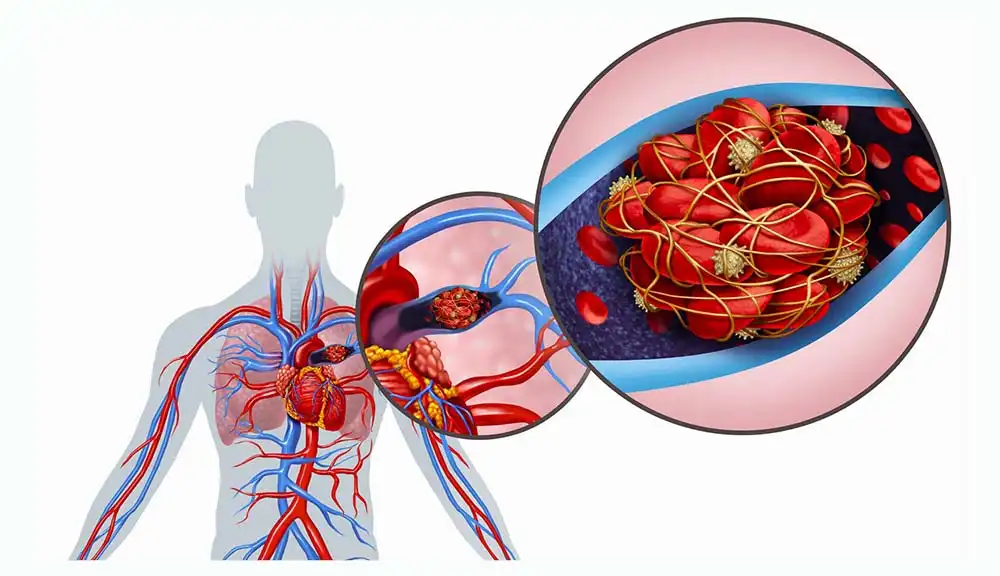 Ответы к тестам НМО: "Выбор антикоагулянта при тромбоэмболии легочной артерии (ТЭЛА) в зависимости от степени риска"