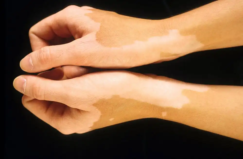 Раскрываем тайны нарушений пигментации кожи: от пятен до рака