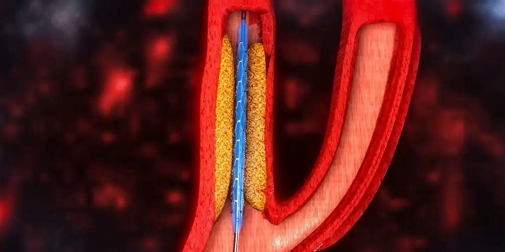 Ответы к тестам НМО: "Диагностика и лечение атеросклероза каротидных артерий"